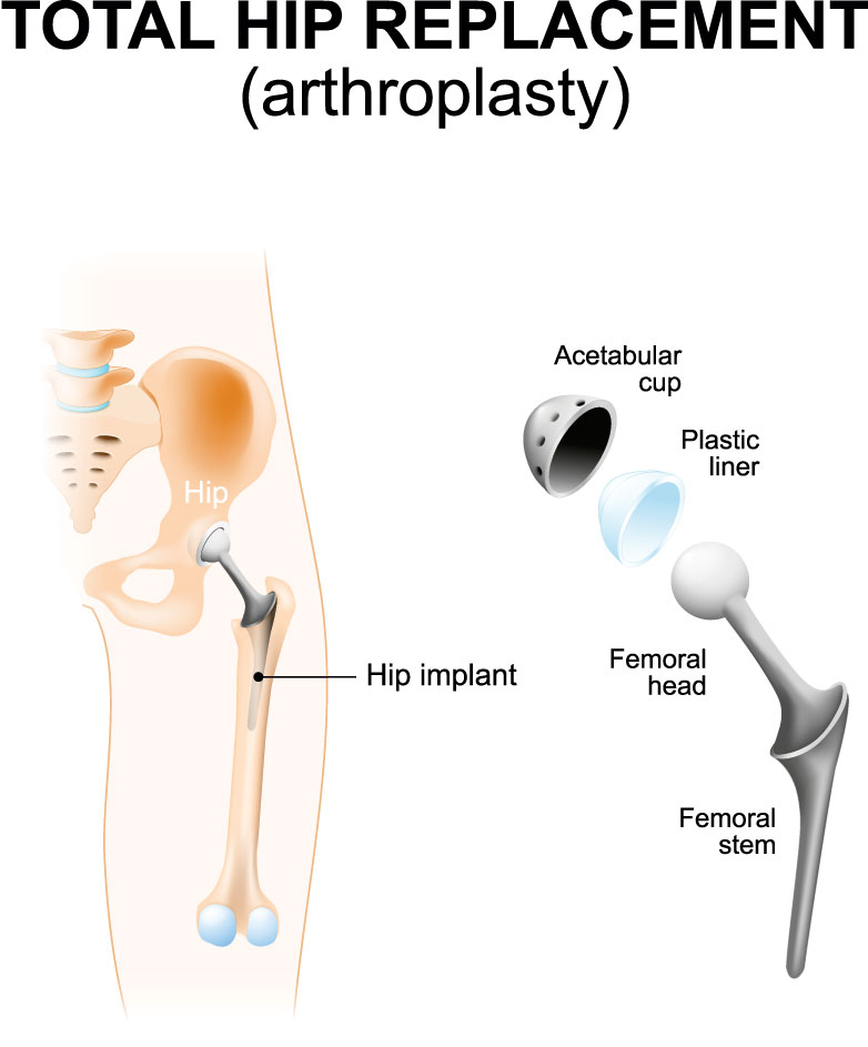 osteoarthritis hip replacement