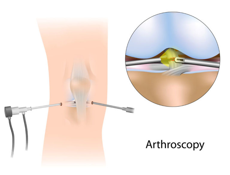 arthroscopy-of-the-knee-knee-scope-schulze-orthopedics